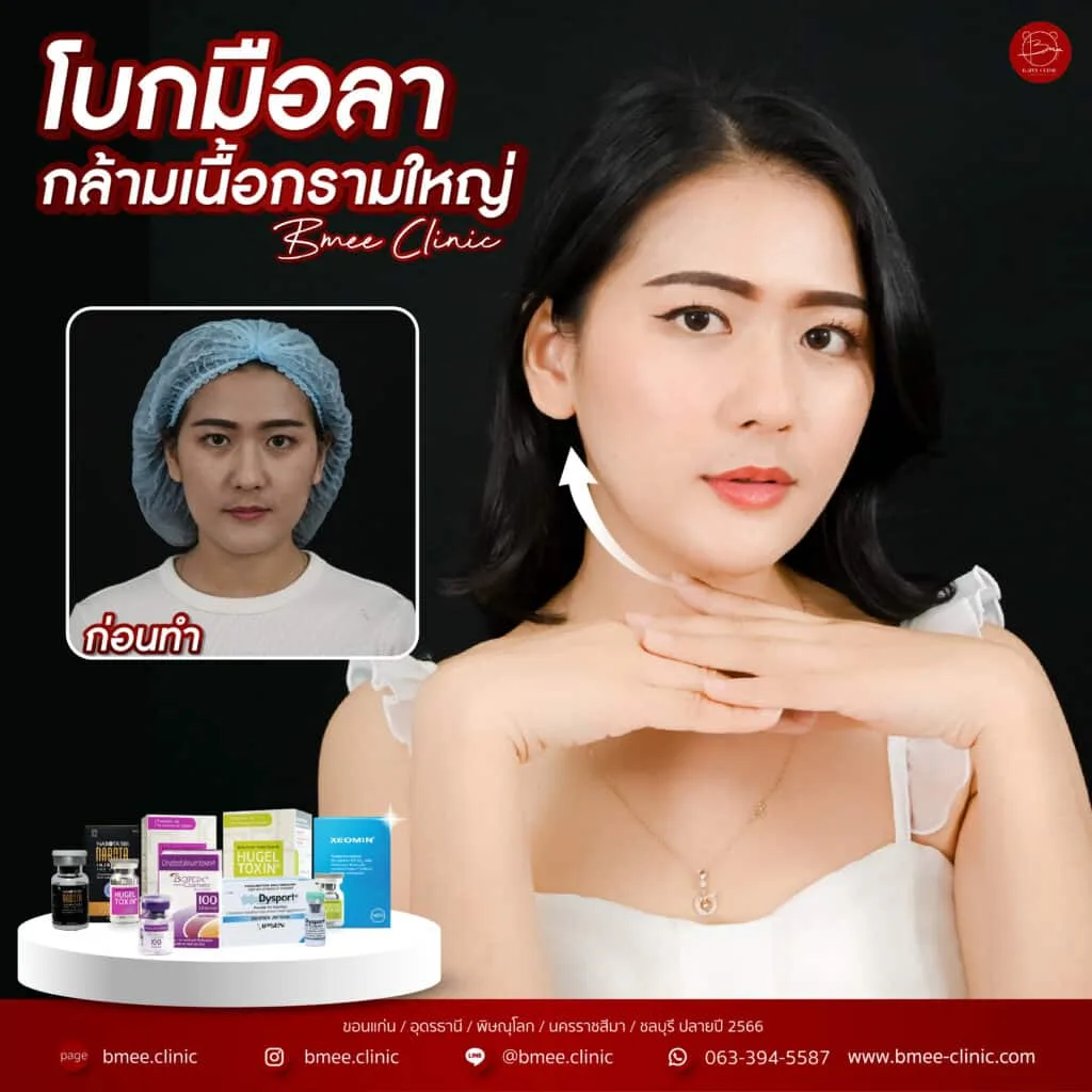 ก่อนและหลังฉีดลดกล้ามเนื้อกราม หน้าเรียว บ้านหมี คลินิก