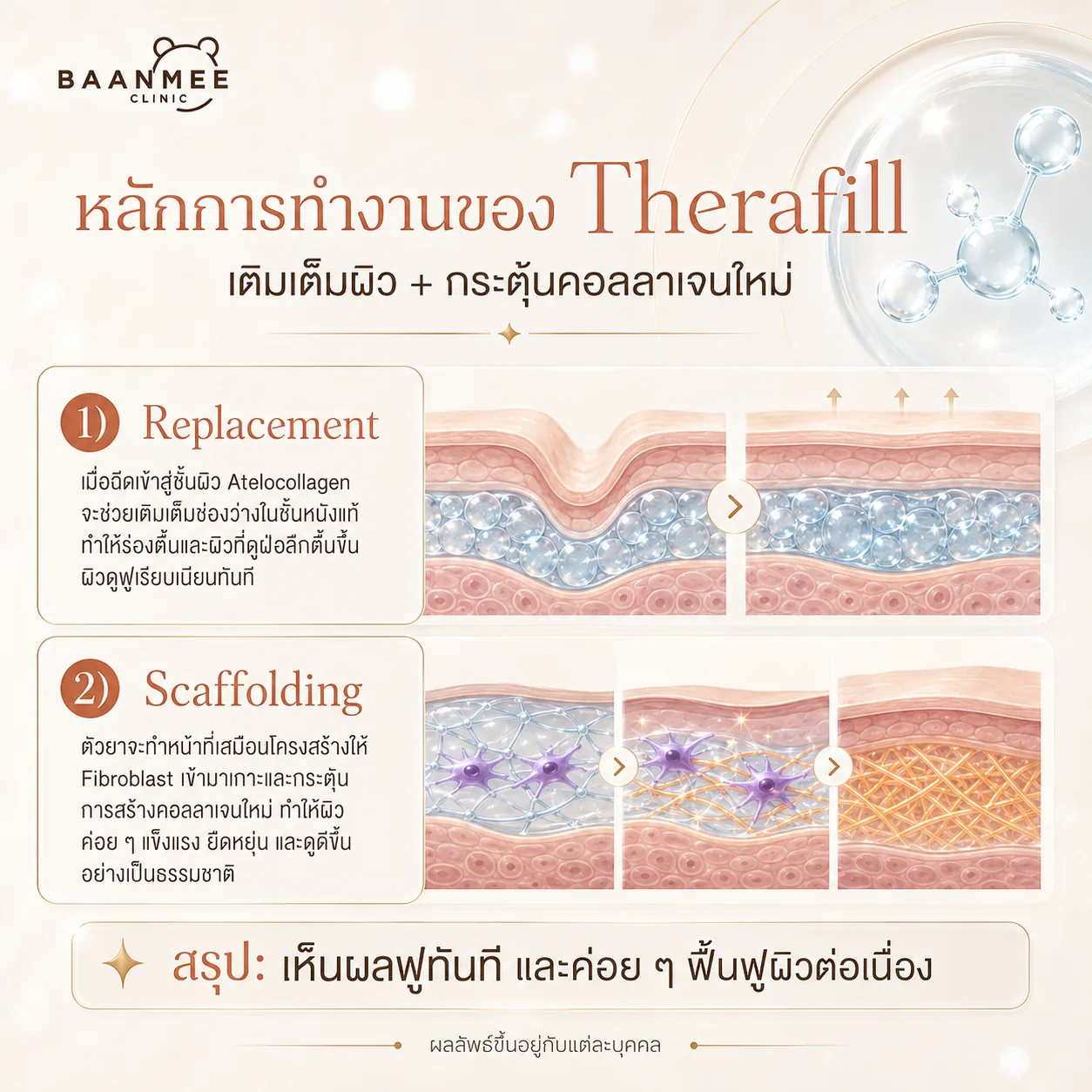 หลักการทำงานของ Therafill Program — Replacement เติมเต็มช่องว่างในชั้นหนังแท้ และ Scaffolding เป็นโครงสร้างให้ Fibroblast สร้างคอลลาเจนใหม่