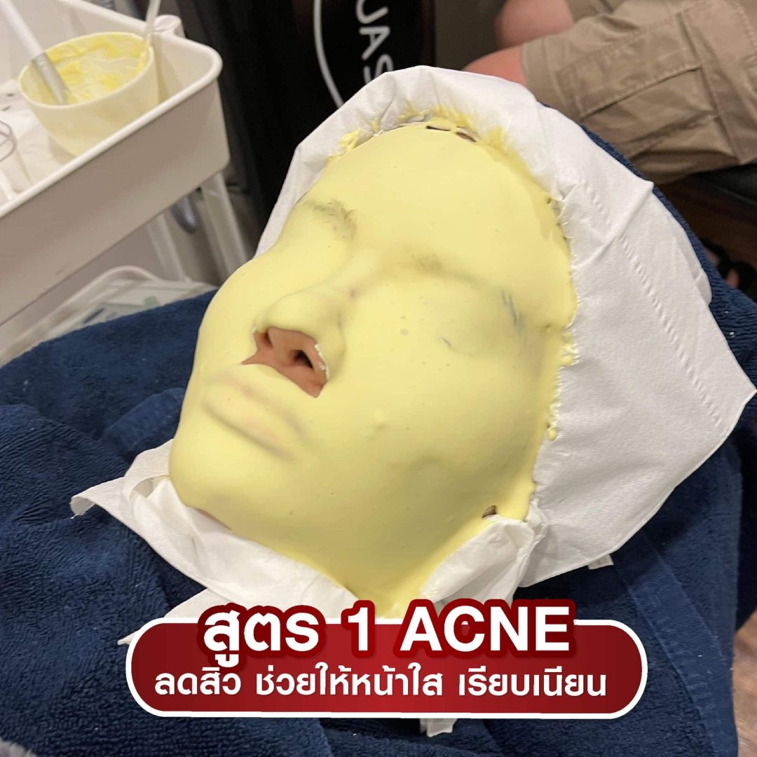 สูตร 1 Acne — ลดสิว