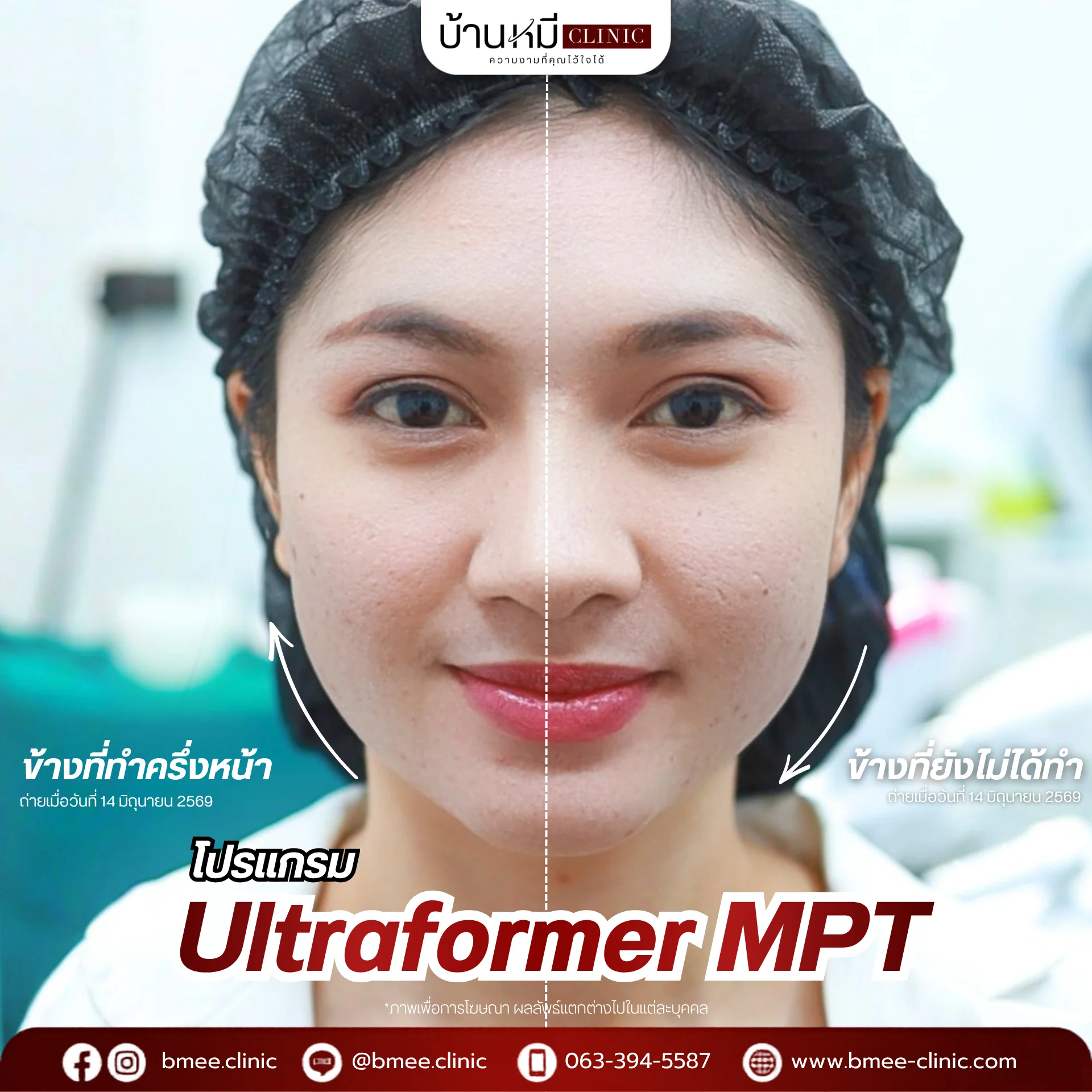 รีวิว Ultraformer MPT จากลูกค้าจริง ภาพที่ 4 บ้านหมีคลินิก