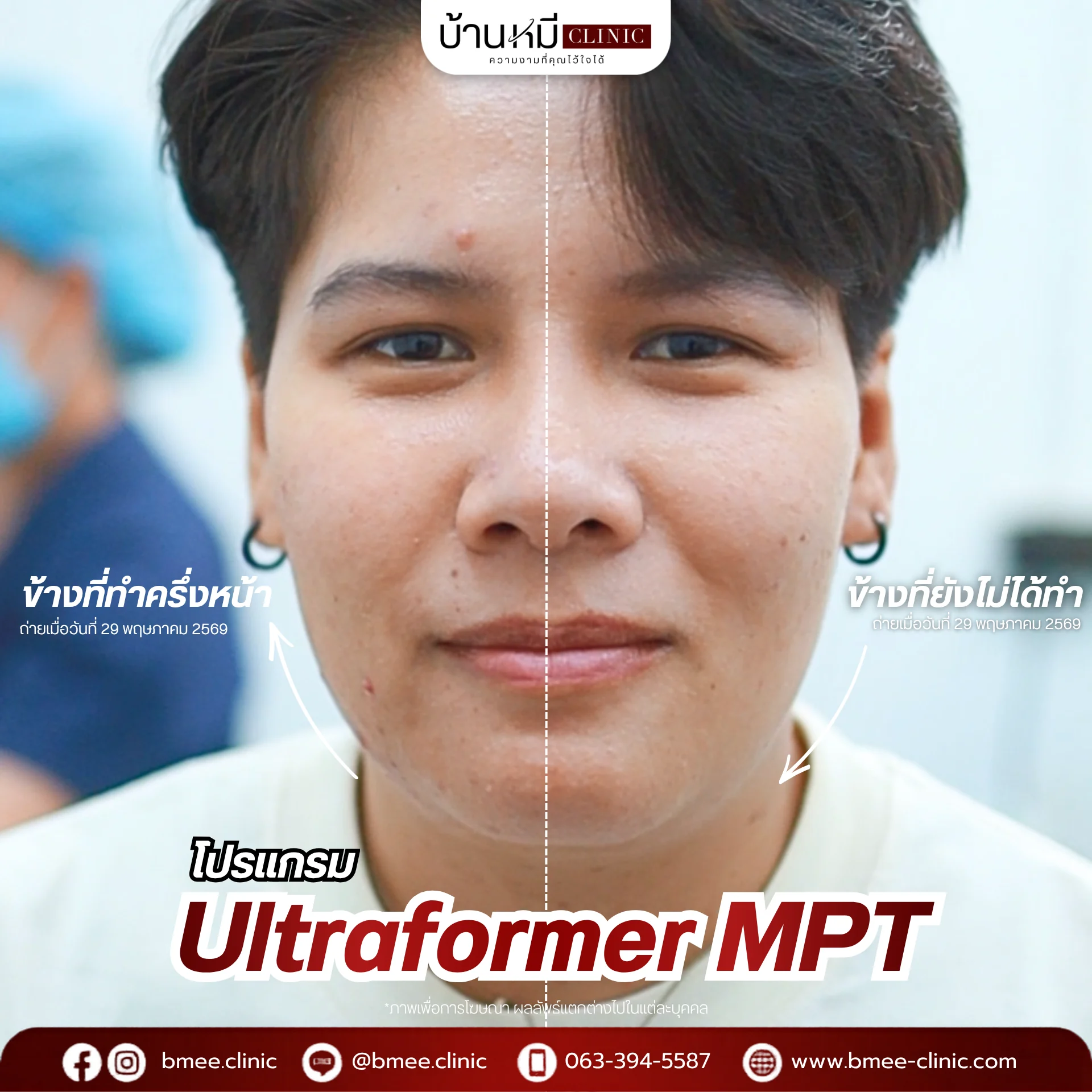 รีวิว Ultraformer MPT จากลูกค้าจริง ภาพที่ 5 บ้านหมีคลินิก