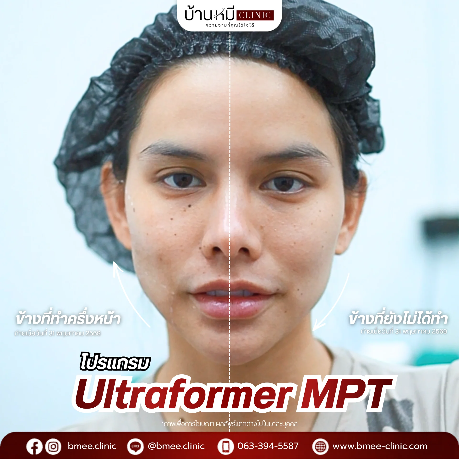 รีวิว Ultraformer MPT จากลูกค้าจริง ภาพที่ 6 บ้านหมีคลินิก