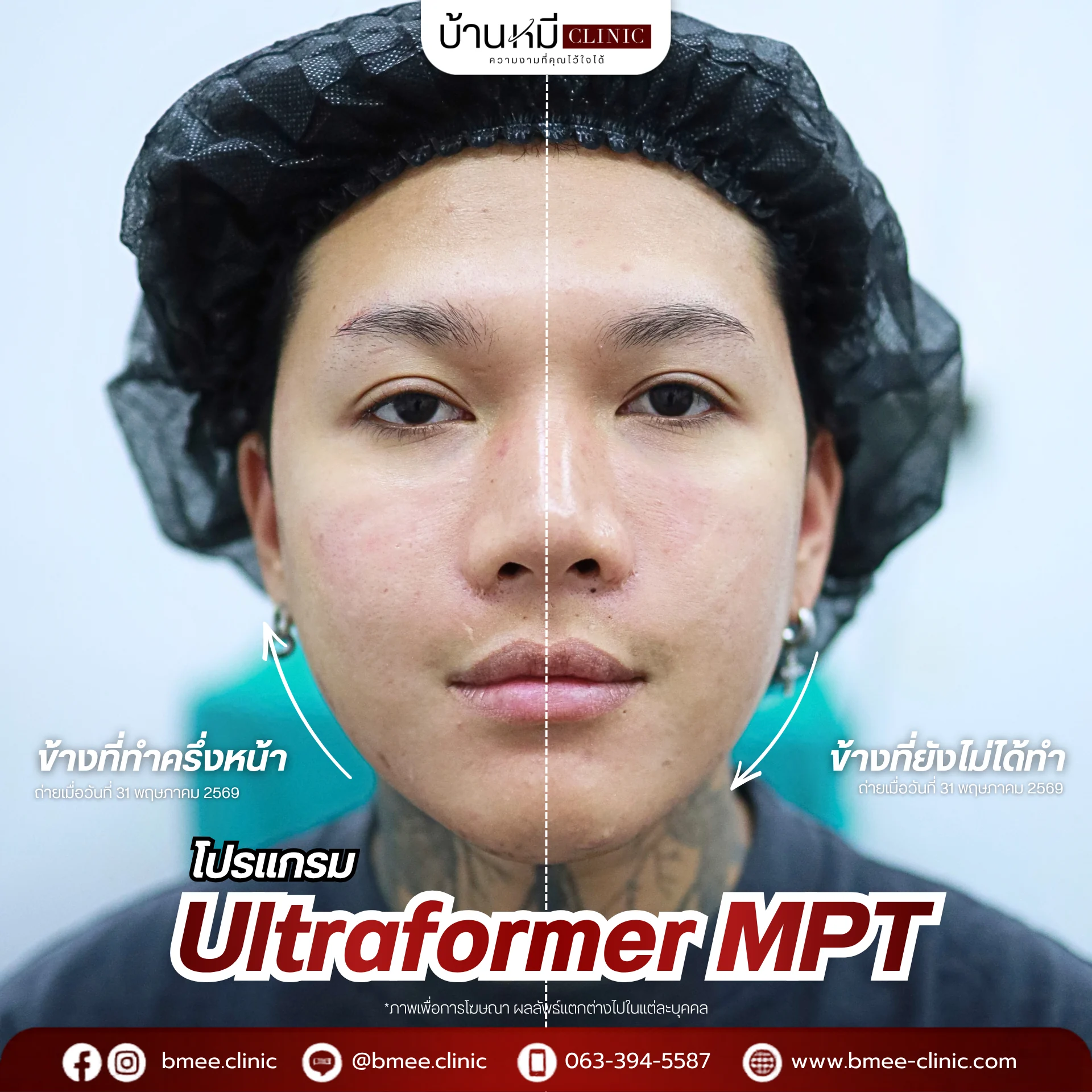 รีวิว Ultraformer MPT จากลูกค้าจริง ภาพที่ 7 บ้านหมีคลินิก