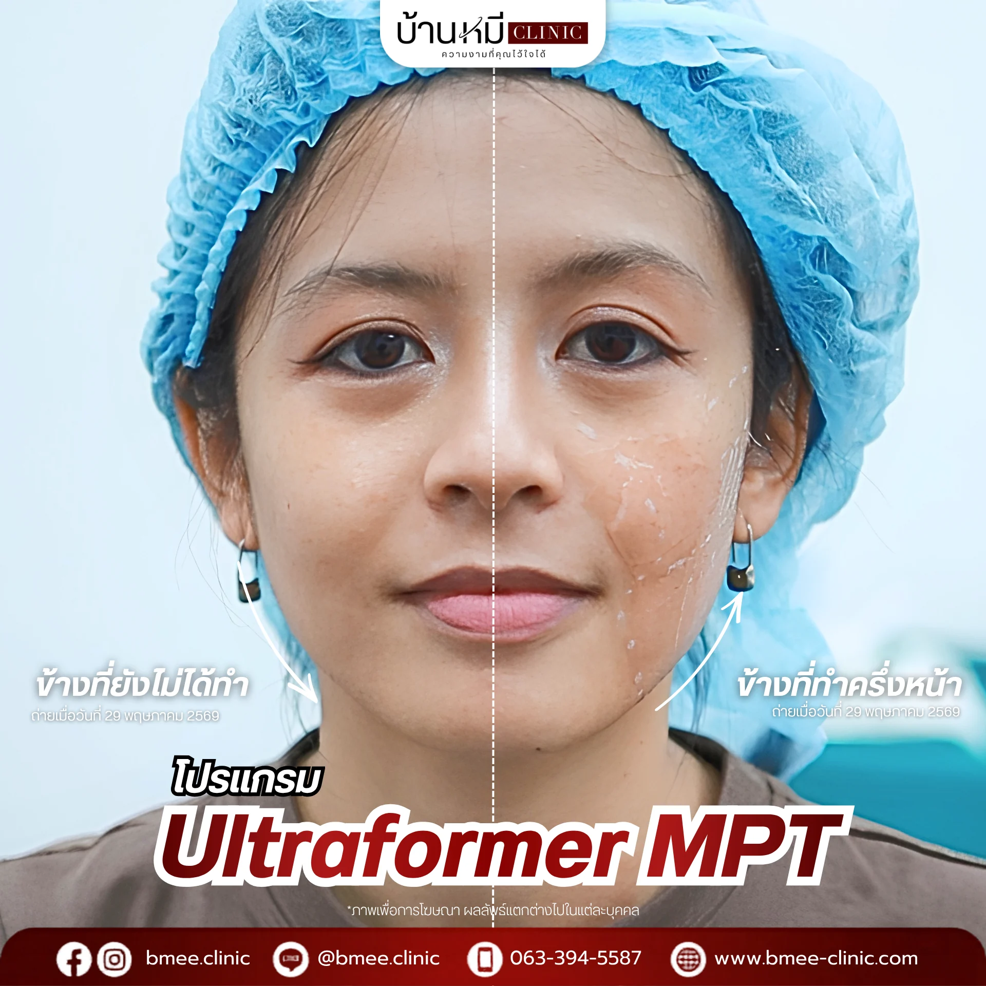 รีวิว Ultraformer MPT จากลูกค้าจริง ภาพที่ 8 บ้านหมีคลินิก